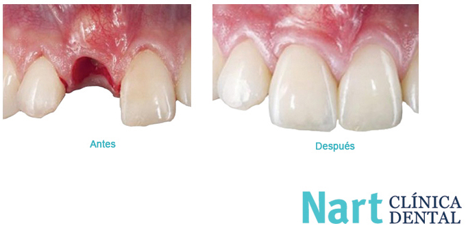 Cómo se coloca un implante dental - caso clínico