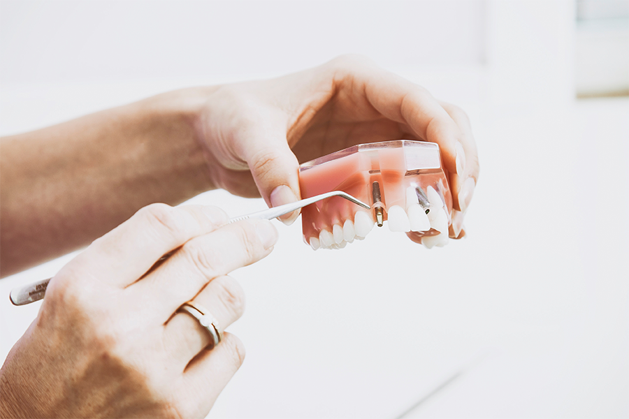 Cómo se coloca un implante dental