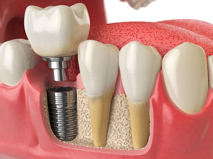 implante dental tornillo de titanio