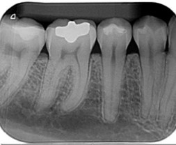 aletas-de-mordida-radiografia